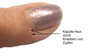 Nagelhaut, Nagelhautpflege, Kaputte Nagelhaut